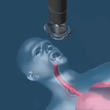 Securilife Family — Anti-choking device (baby, child, adult) - Saves lives in 10 seconds